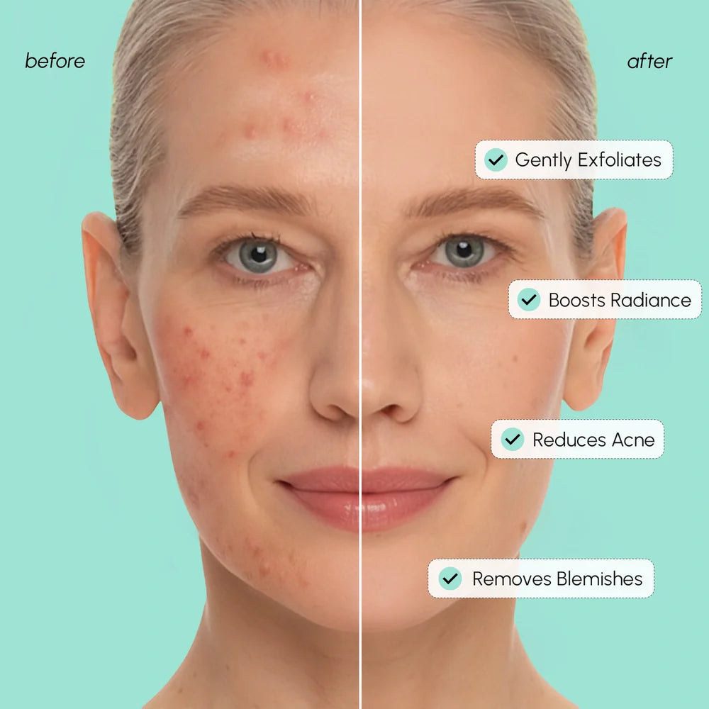 Azelaic Acid Soothing Pads - Ashunta Sheriff Beauty